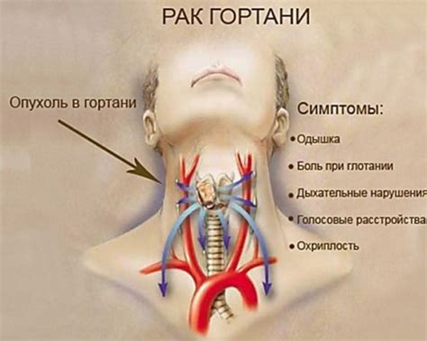 Симптомы, указывающие на образование аномального узла в области горла