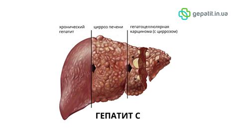 Симптомы гепатомегалии почек