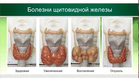 Симптомы гетерогенного образования щитовидной железы