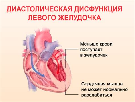 Симптомы гипокинезии миокарда левого желудочка: