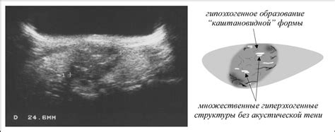 Симптомы гипоэхогенного аваскулярного образования