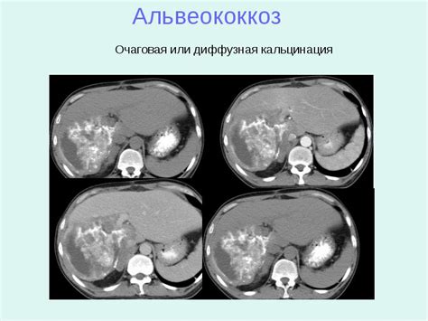 Симптомы гипоэхогенного образования в печени