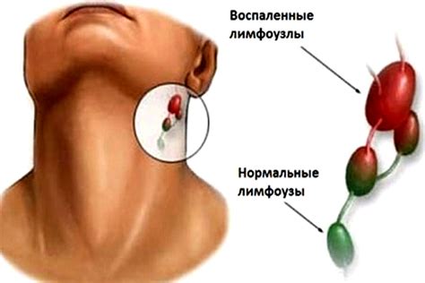 Симптомы гипоэхогенного образования на шее