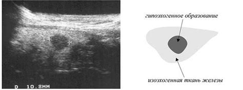 Симптомы гипоэхогенного тяжа