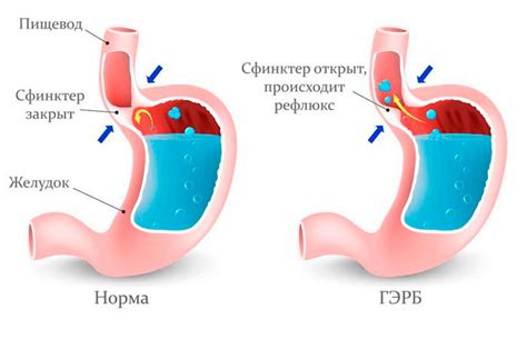 Симптомы гэрб