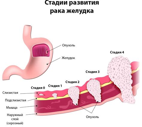 Симптомы гэрба желудка