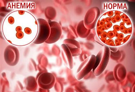 Симптомы и признаки недостаточного уровня гемоглобина