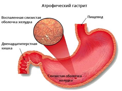 Симптомы и проявления гетеротопии слизистой желудка