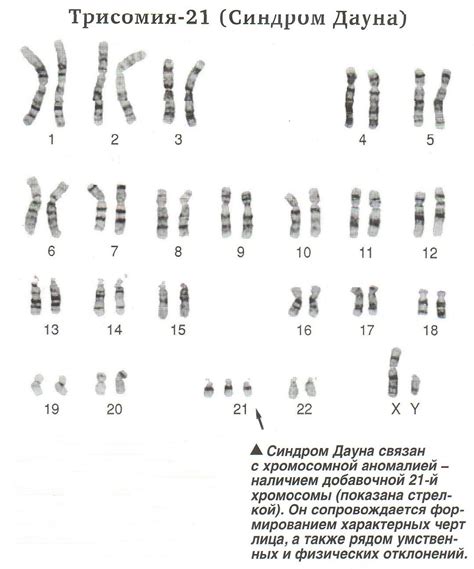 Синдром Дауна и другие аномалии хромосом: что нужно знать