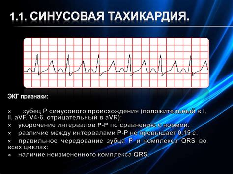 Синусовая тахикардия: сущность и факторы возникновения