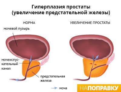 Сравнение механизма действия двух препаратов при лечении аденомы предстательной железы