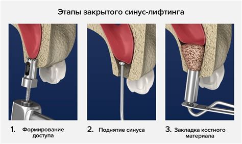 Сущность процедуры синус лифтинга и его влияние