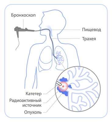 Типы гипофракционирования в лучевой терапии