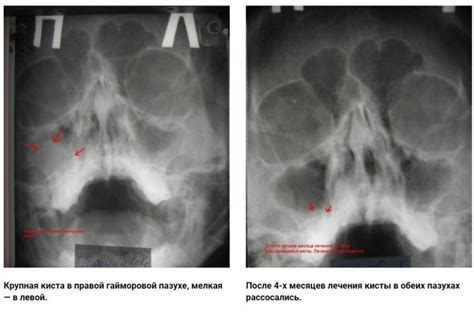 Традиционные подходы к лечению кисты в полостях носа: эффективность и потенциальные риски