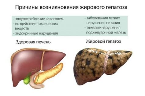 Угрозы и осложнения гепатоза стеатоза печени