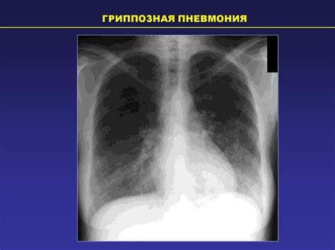 Ультразвуковое исследование при выявлении воспалительных изменений в легких