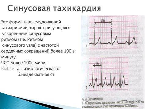 Управление физической активностью и контроль пульса при синусовой тахикардии