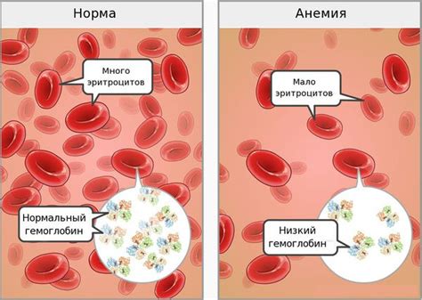 Факторы, влияющие на дефицит железа при нормальном содержании гемоглобина