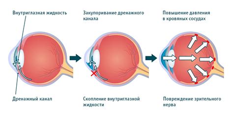 Факторы, способствующие повышению давления в глазах