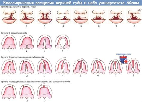 Факты о манипуляции с нежной структурой губы у новорожденных