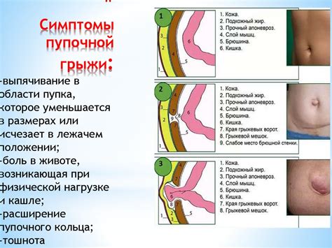 Физиология пупочной грыжи и воздействие на брюшную полость: ключевые аспекты