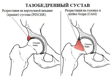 Хроническая боль и ограничение движений: проблемы, связанные с первым суставом плюснефалангового сустава стопы