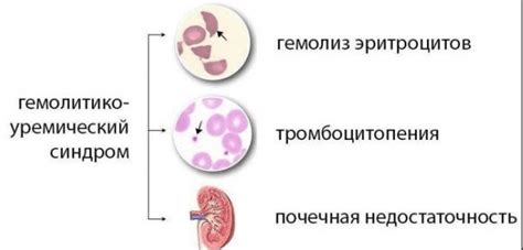 Хронический гемолитический синдром