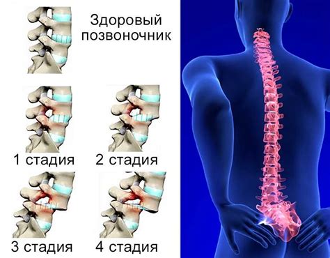 Что вы знаете о смещении позвонков и как определить его наличие?