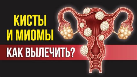 Что такое гиалиноз узла миомы и почему он возникает