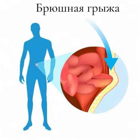 Что такое грыжа и какие факторы могут вызвать ее возникновение?