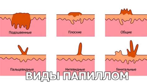 Эффект "молниеносного" развития папилломы: факт или миф?