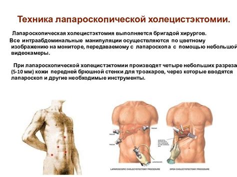  Важность проколов при холецистэктомии