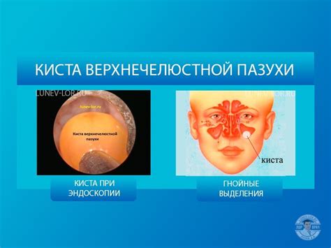  Основы кисты в верхнечелюстной пазухе 